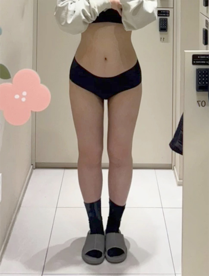 After thigh liposuction of Ddklose in Korea—front view in black socks, thighs appear slimmer with clear gap.