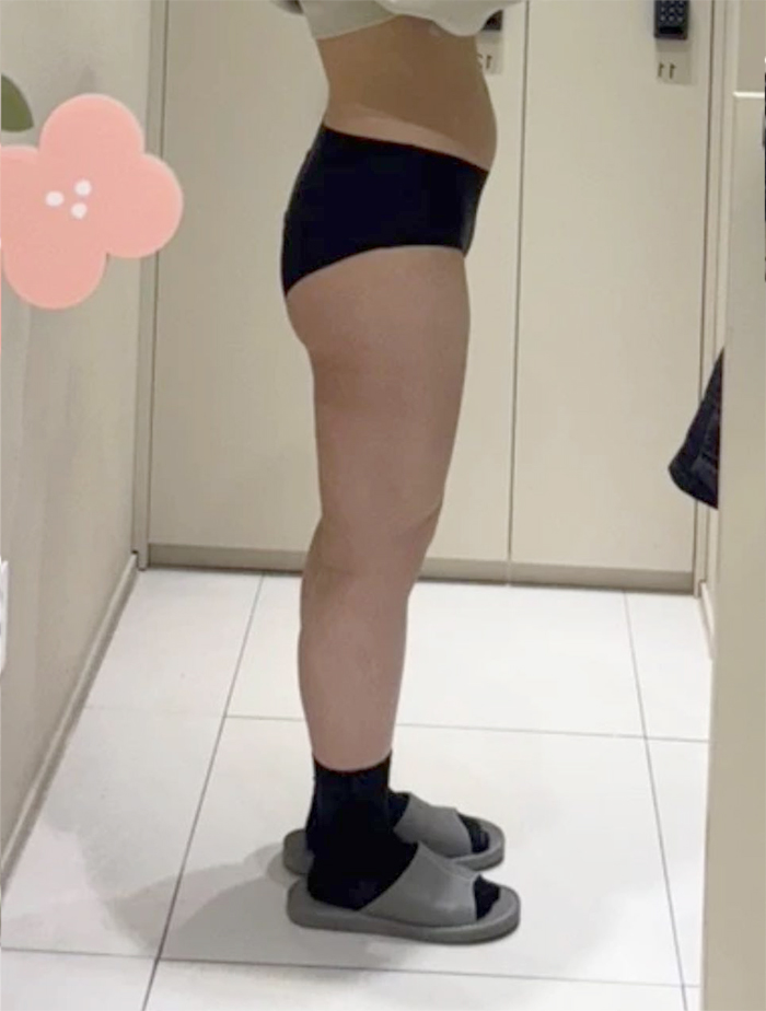 After thigh liposuction of Ddklose in Korea—front view in black socks, thighs appear slimmer with clear gap.