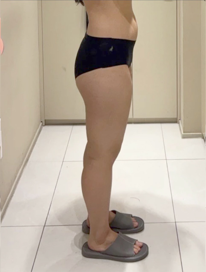 Before thigh liposuction of Ddklose in Korea—side view, visible volume and outer thigh bulge.