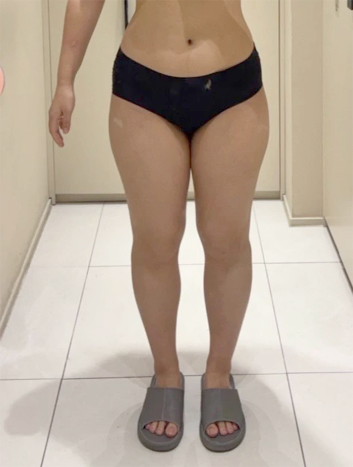 Before thigh liposuction of Ddklose in Korea—front view in underwear, thick thighs with minimal gap.