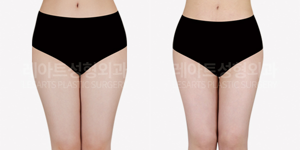 full_body_liposuction_01_thumbnail_250123