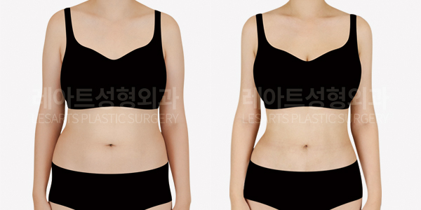 full_body_liposuction_01_thumbnail_250213