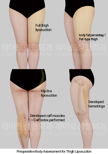 full_body_liposuction_02_01_250123