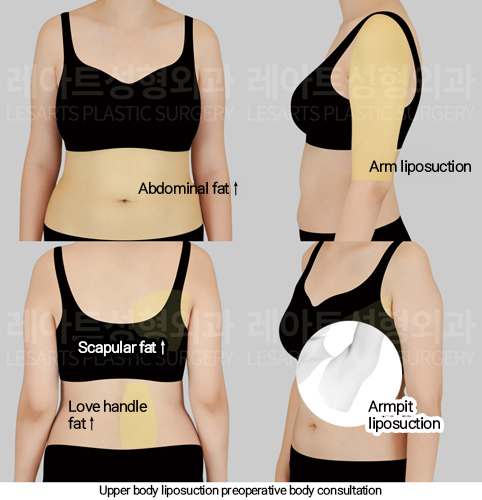 full_body_liposuction_02_01_250213