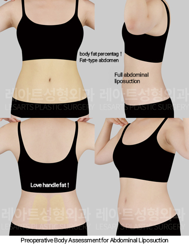 full_body_liposuction_02_02_250123