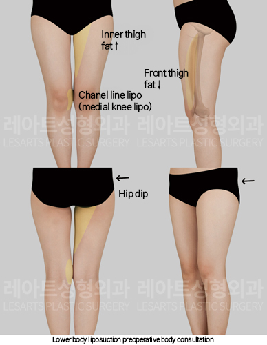 full_body_liposuction_02_02_250213