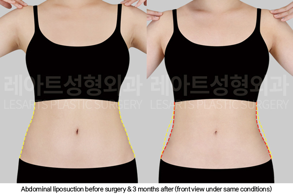 full_body_liposuction_02_03_250123