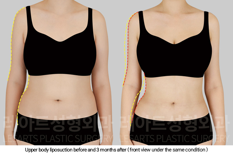 full_body_liposuction_02_03_250213