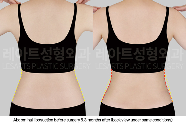 full_body_liposuction_02_04_250123