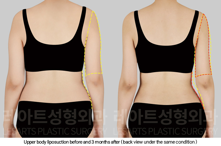 full_body_liposuction_02_04_250213