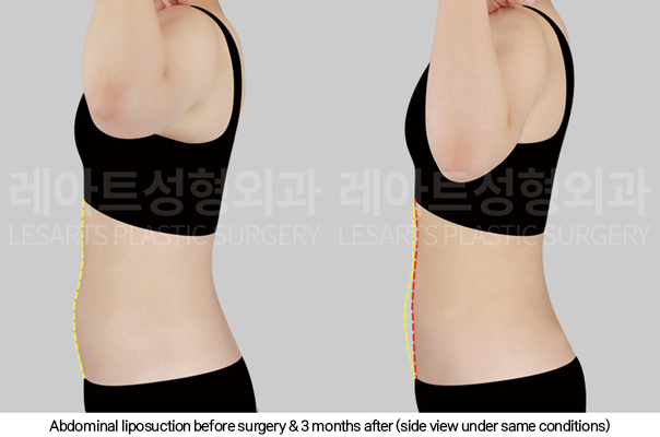 full_body_liposuction_02_05_250123