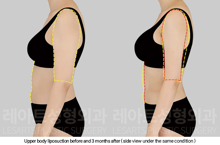 full_body_liposuction_02_05_250213