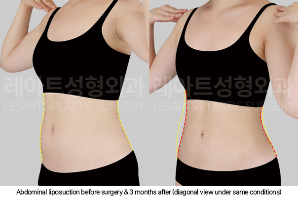 full_body_liposuction_02_06_250123