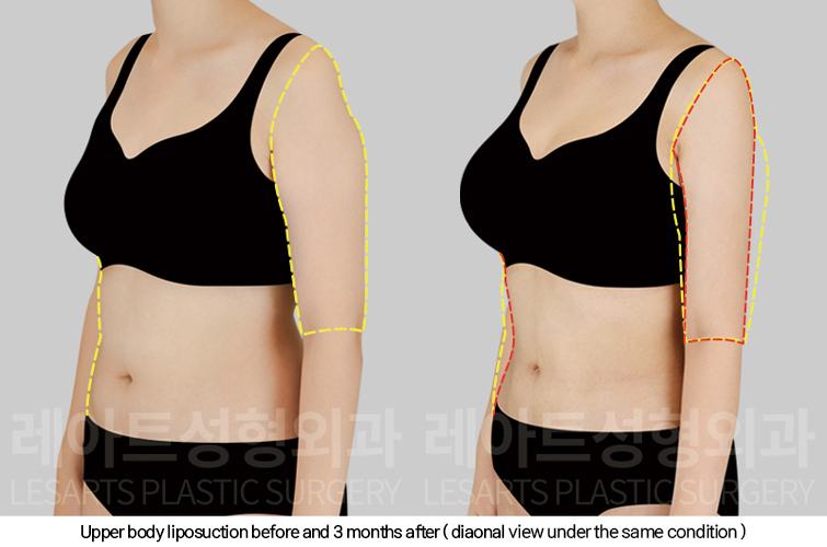 full_body_liposuction_02_06_250213