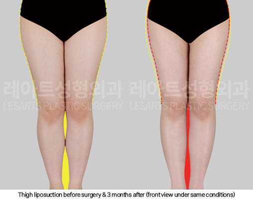 full_body_liposuction_02_07_250123