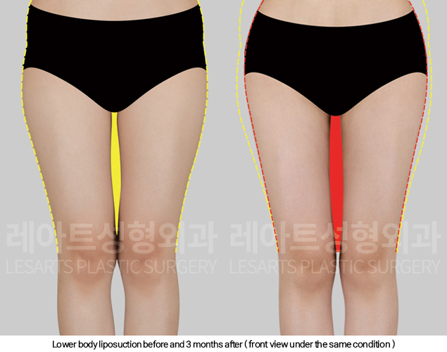 full_body_liposuction_02_07_250213
