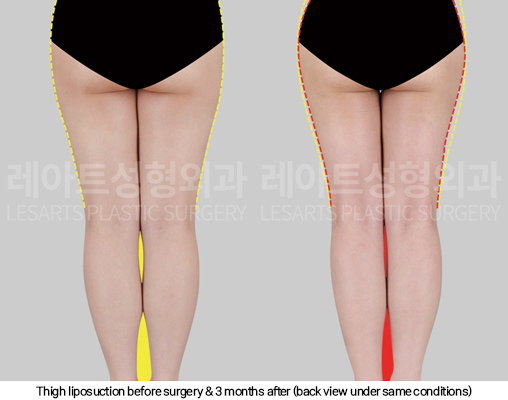 full_body_liposuction_02_08_250123