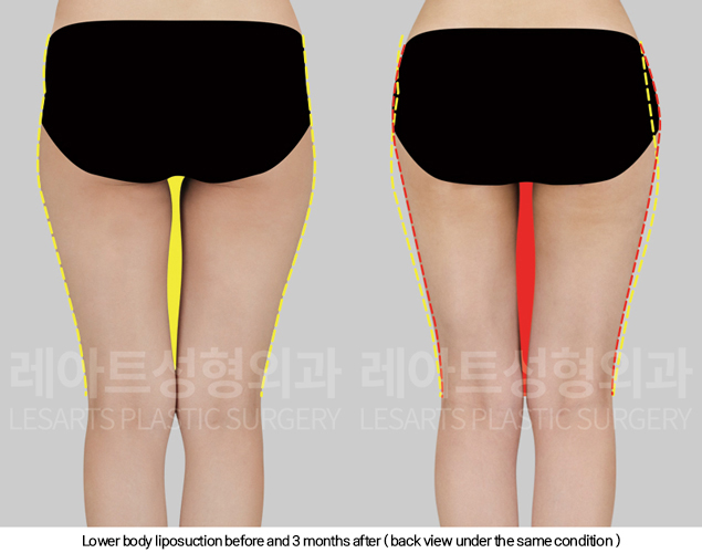 full_body_liposuction_02_08_250213