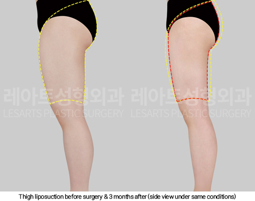 full_body_liposuction_02_09_250123