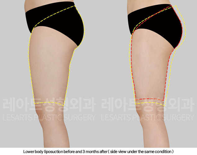 full_body_liposuction_02_09_250213