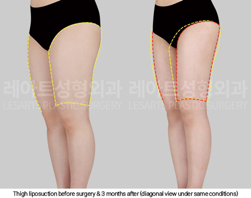 full_body_liposuction_02_10_250123