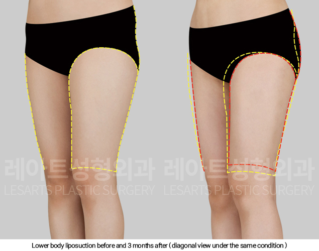 full_body_liposuction_02_10_250213