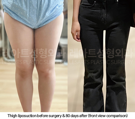 full_body_liposuction_02_11_250123