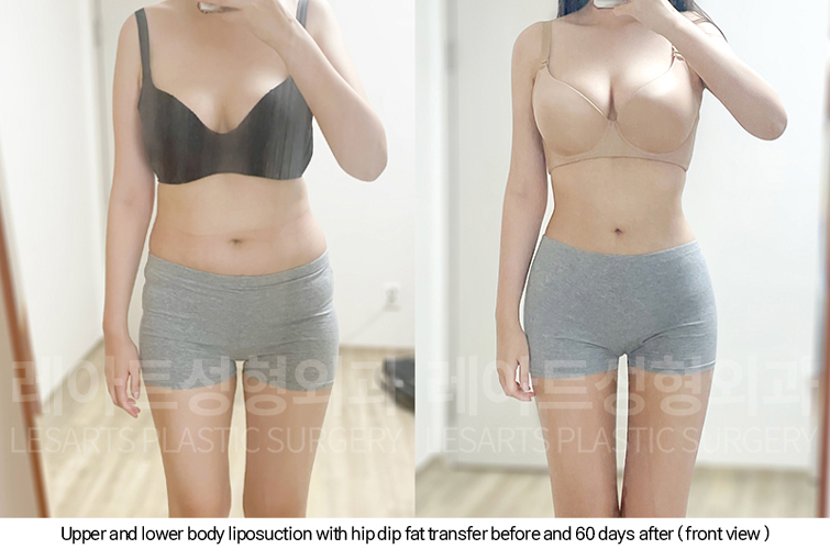 full_body_liposuction_02_11_250213