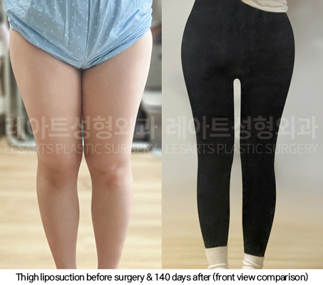 full_body_liposuction_02_12_250123