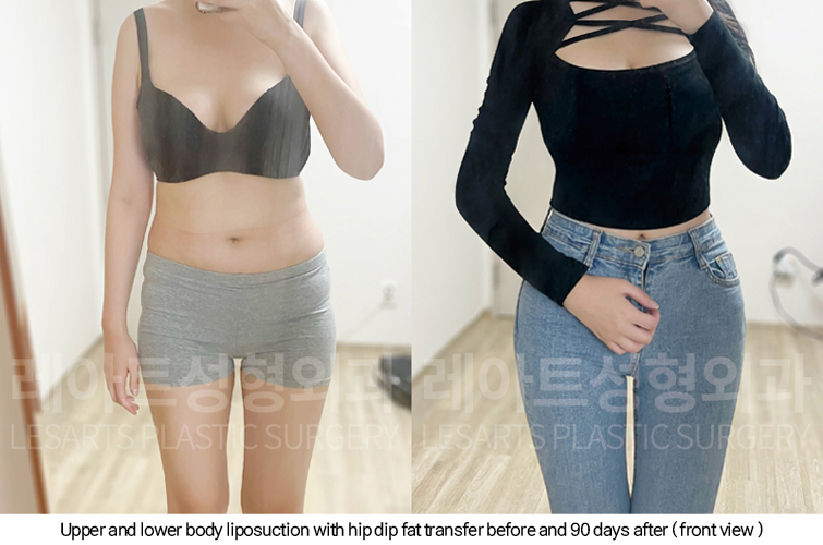 full_body_liposuction_02_13_250213