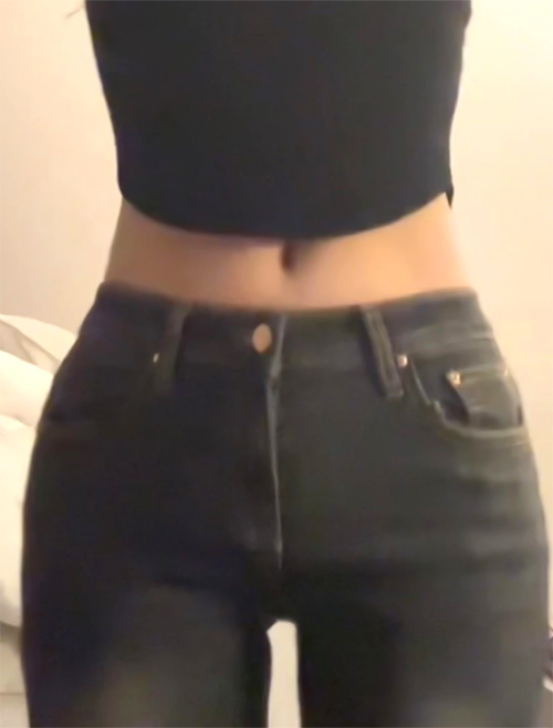 Post-surgery photo of hmemend after thigh liposuction, visible hip curve improvement.