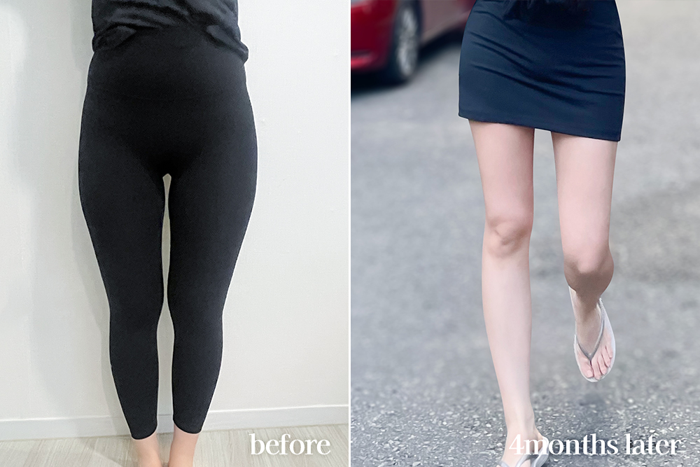 thighLiposuction-review