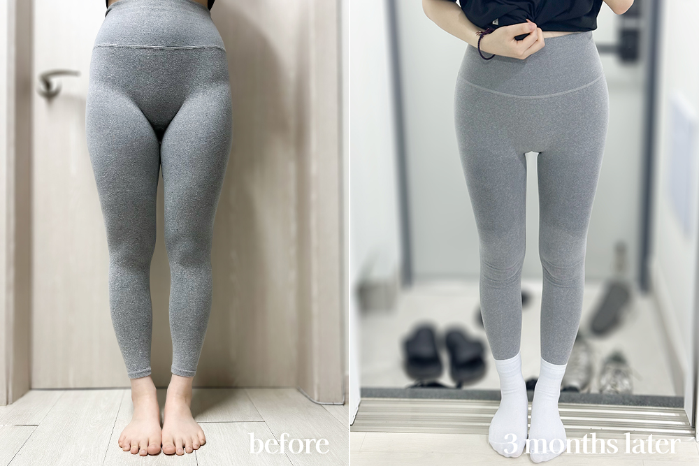 thighLiposuction-review