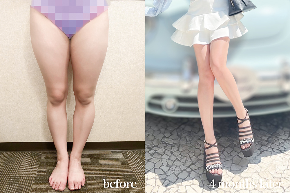 thighLiposuction-review