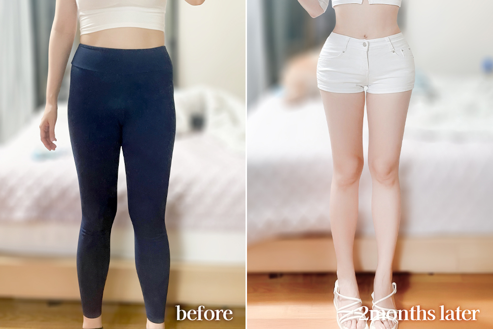 thighLiposuction-review