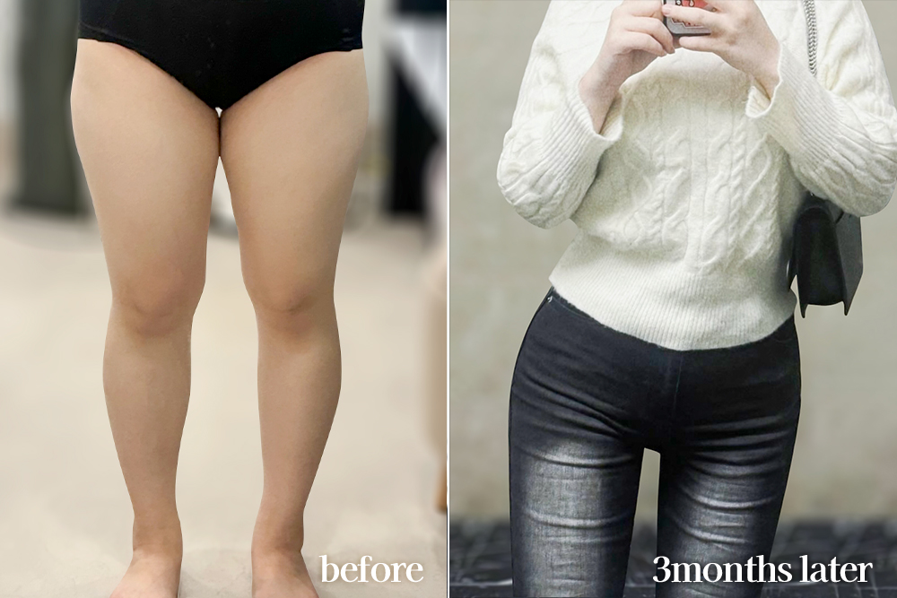 thighLiposuction-review