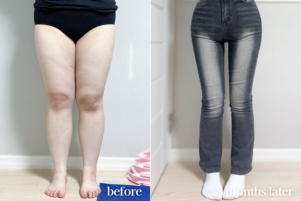 thighLiposuction-review