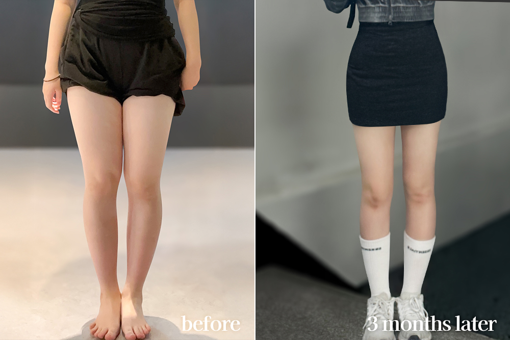 thighLiposuction-review