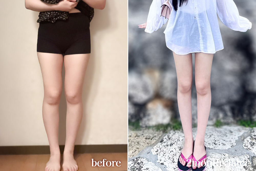 thighLiposuction-review