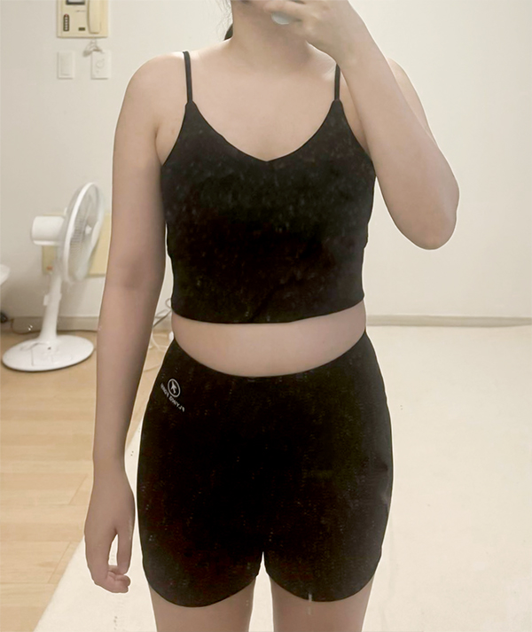 lucia00's body before arm and abdominal liposuction at Lesarts Plastic Surgery in Korea