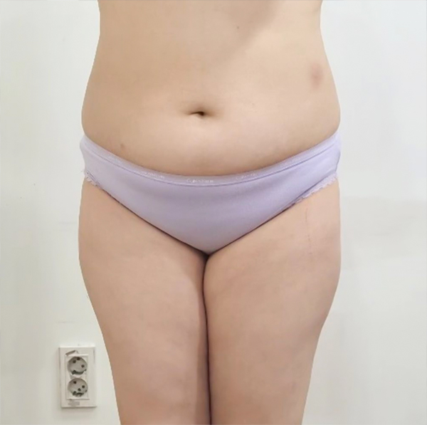 meongkomam's body before tummy tuck and hip fat transfer at Lesarts Plastic Surgery in Korea