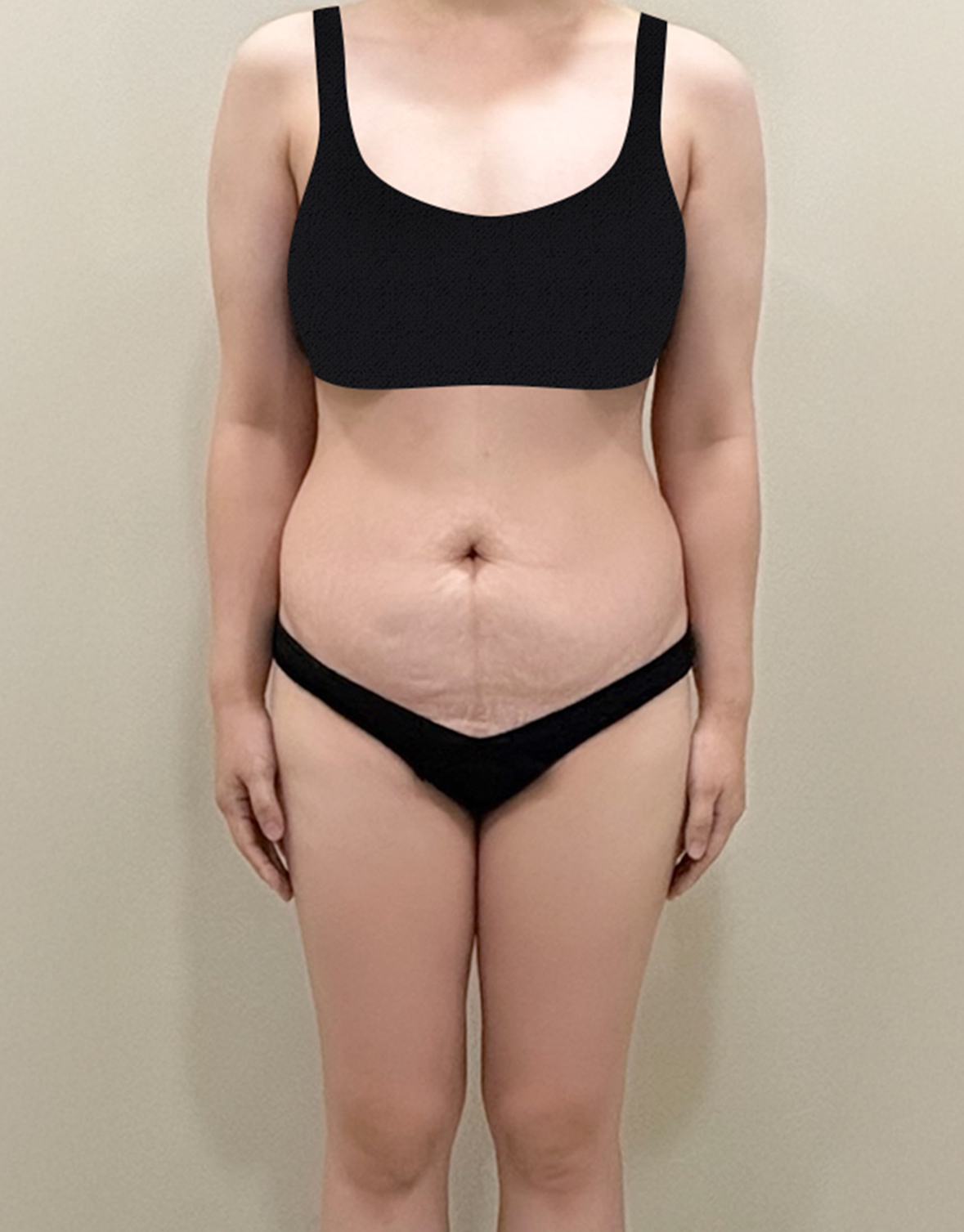 Before photo of thdsk0810 showing belly stretch marks and lower abdominal fat before tummy tuck in Korea.