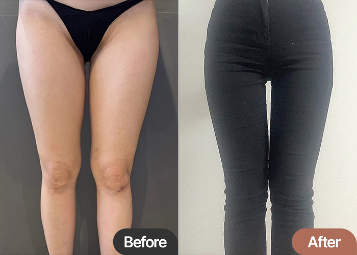 Before and after comparison showing Bebibebibaby’s leg transformation after thigh liposuction in Korea.