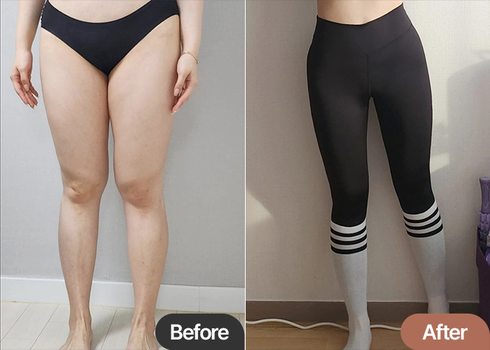 Before and after comparison of Ceerri’s thigh liposuction in Korea—thinner knees and improved leg symmetry.