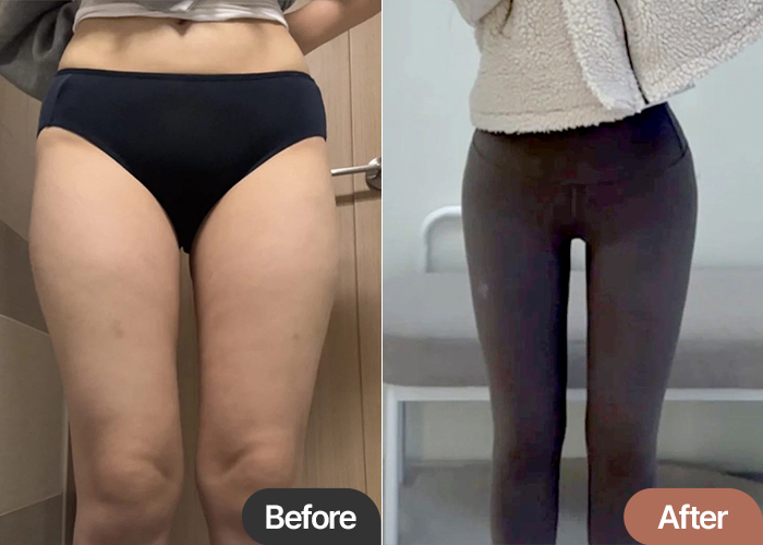 Before and after thigh liposuction and buttocks fat transfer of Hari in Korea—significant improvement in lower body contour and posture.