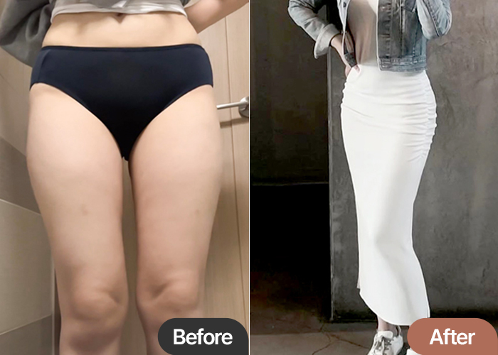 Before and after comparison of hariip showing dramatic leg contour change after thigh liposuction and hip fat transfer at Lesarts in Korea
