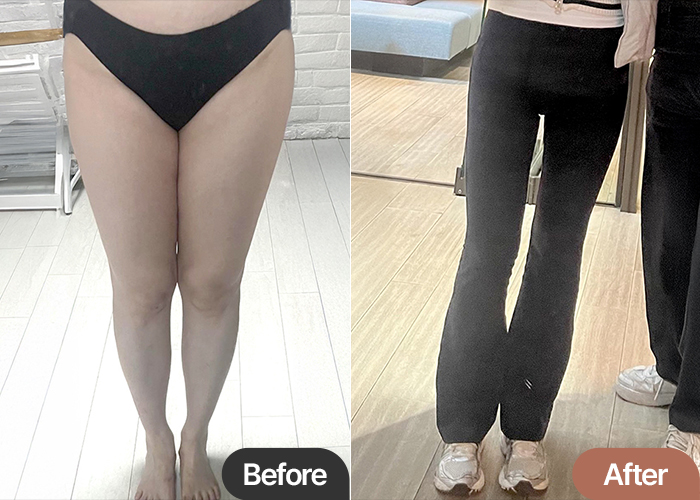 Before and after comparison of thigh liposuction results by YeouRcrOg at Lesarts Plastic Surgery in Korea