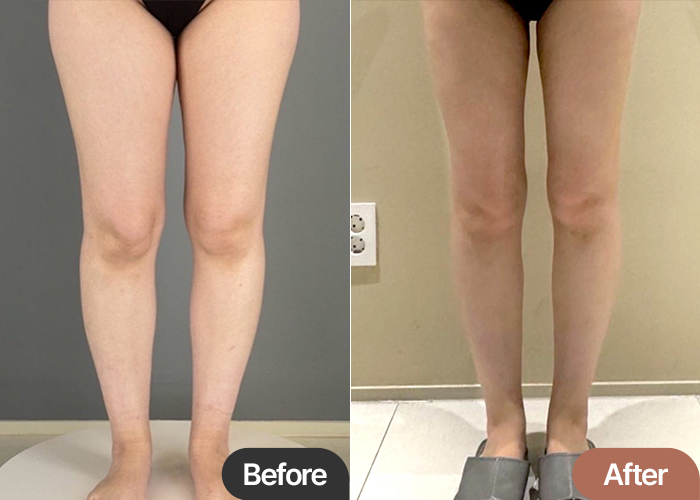 thigh-liposuction-thumbnail-selfie-Baegopak