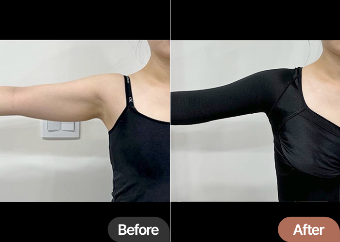 thigh-liposuction-thumbnail-selfie-Dalddalijjoa