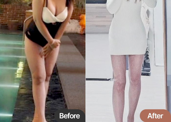 Before and after liposuction of GudGudJjang in Korea—noticeable change in thigh gap and overall arm-leg balance.